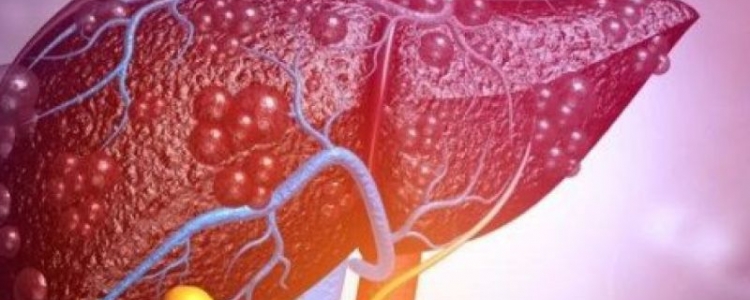 KARACİĞER YAĞLANMASI